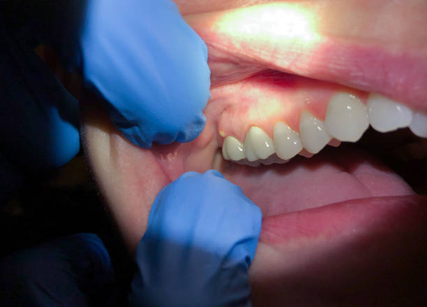 Best Emergency Root Canal Treatment in Wharton, NJ