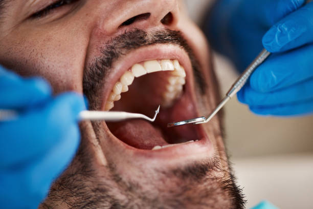 Best Emergency Wisdom Teeth Removal in Wharton, NJ